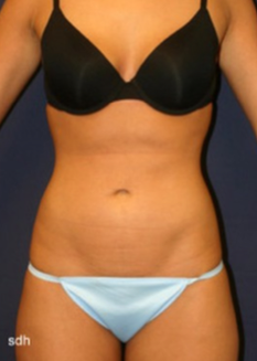 Liposuction-after